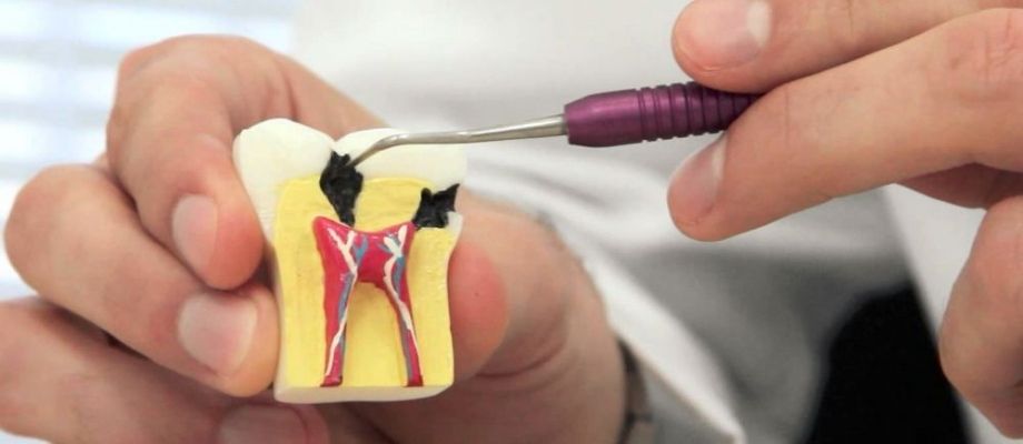 What is a Root Canal treatment?