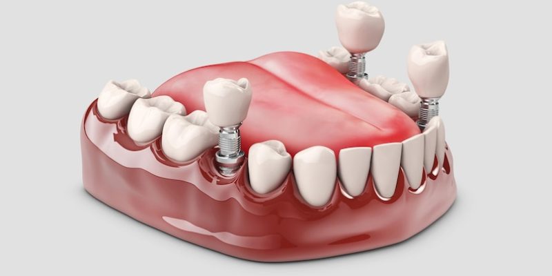 Dental Implants