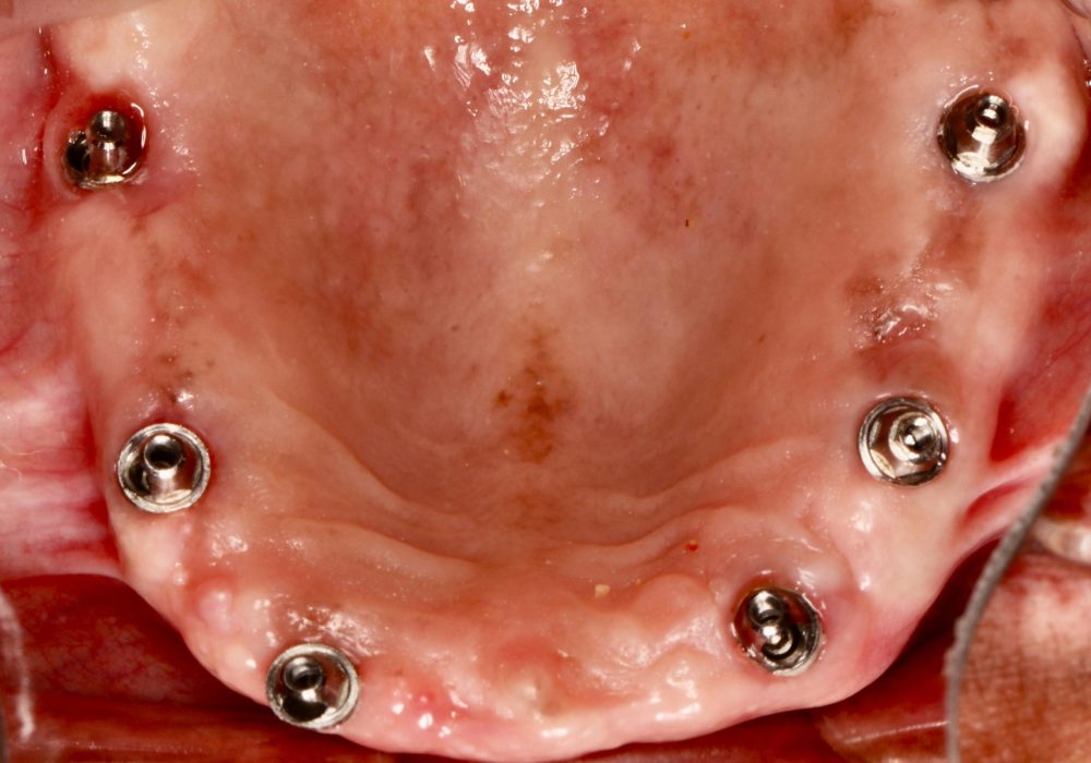 After Endosseus Implant Placement Upper Arch