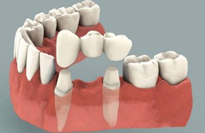 crown-bridge-willow-springs-dental