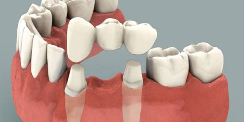 crown-bridge-willow-springs-dental crown-bridge-willow-springs-dental