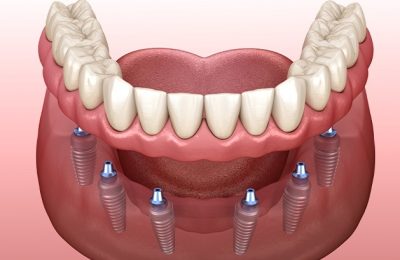 prosthodonticspecial-2