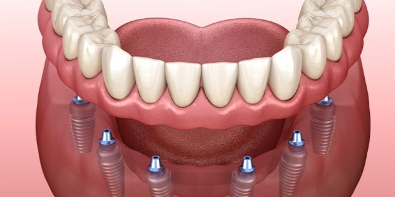 prosthodonticspecial-2